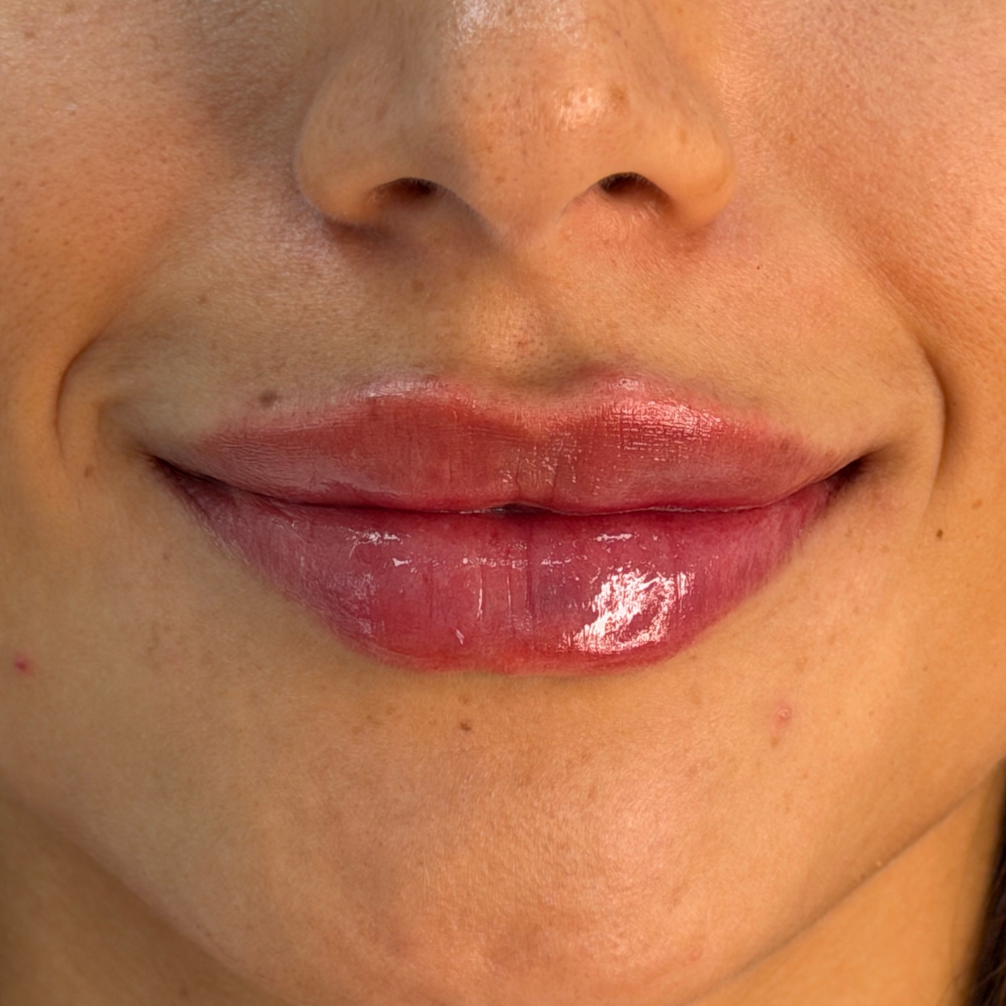 Labios con ácido hialurónico
